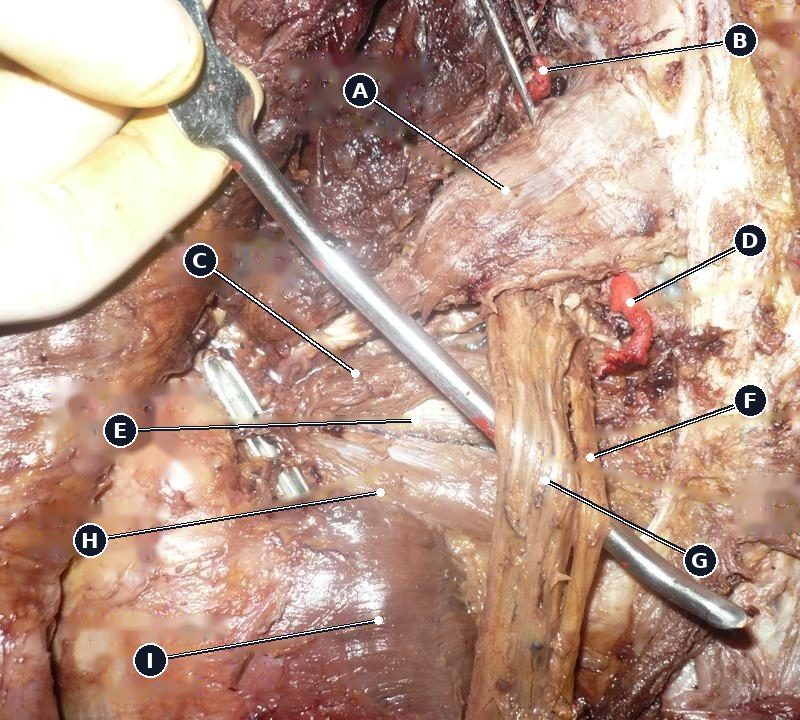 Labelled cadaveric dissection of the deep gluteal region